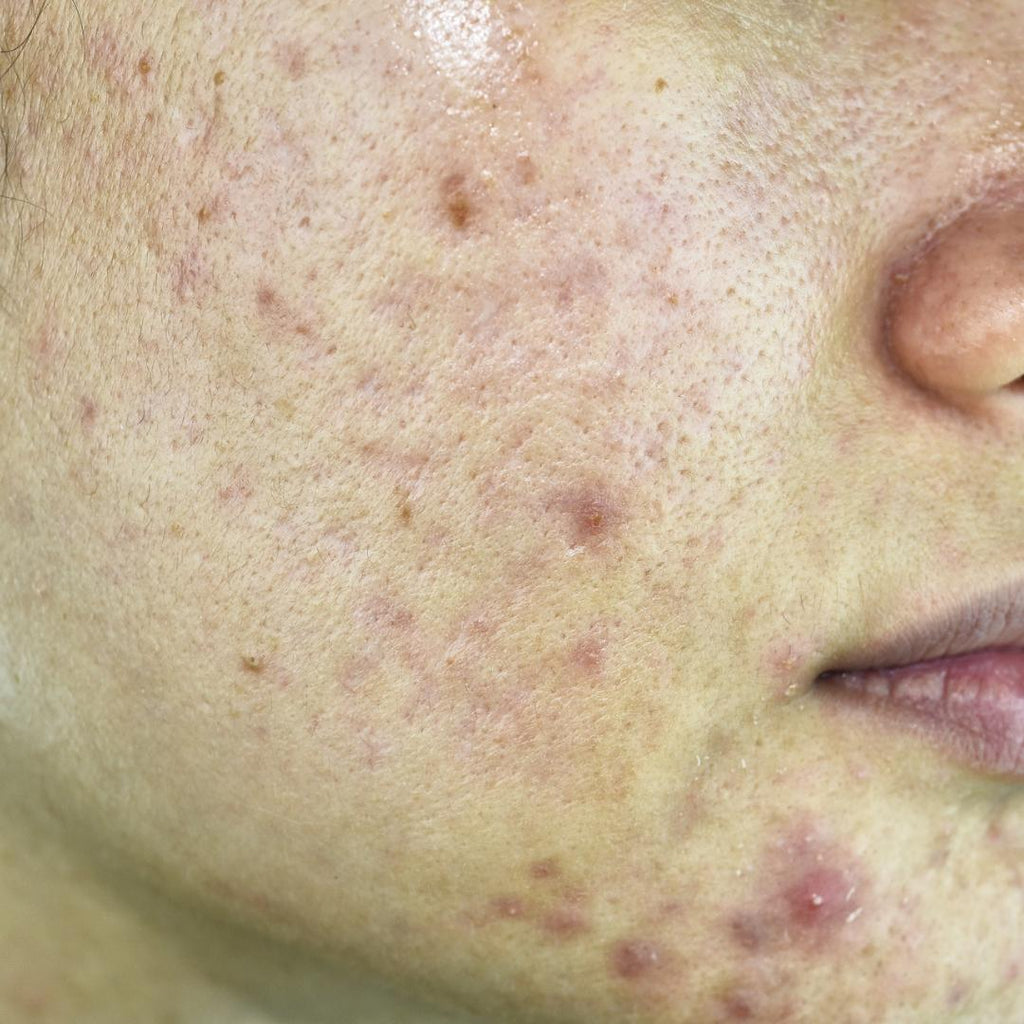 What are the types of Acne?
