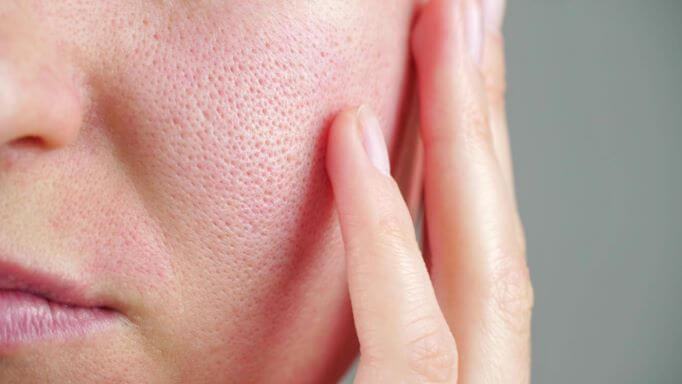What does pore size have to do with acne control?